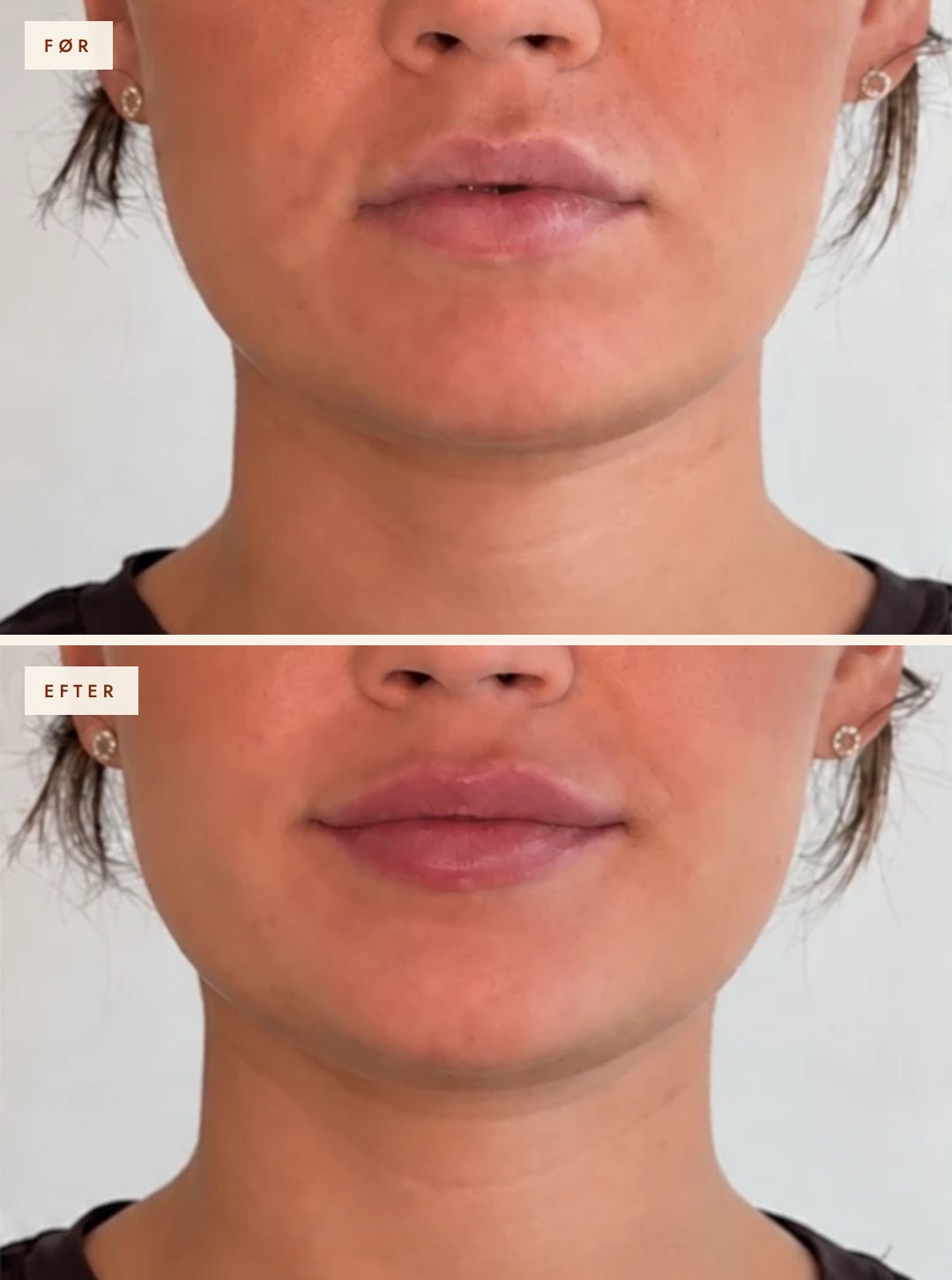 Læber før og efter filler, 0,8 ml