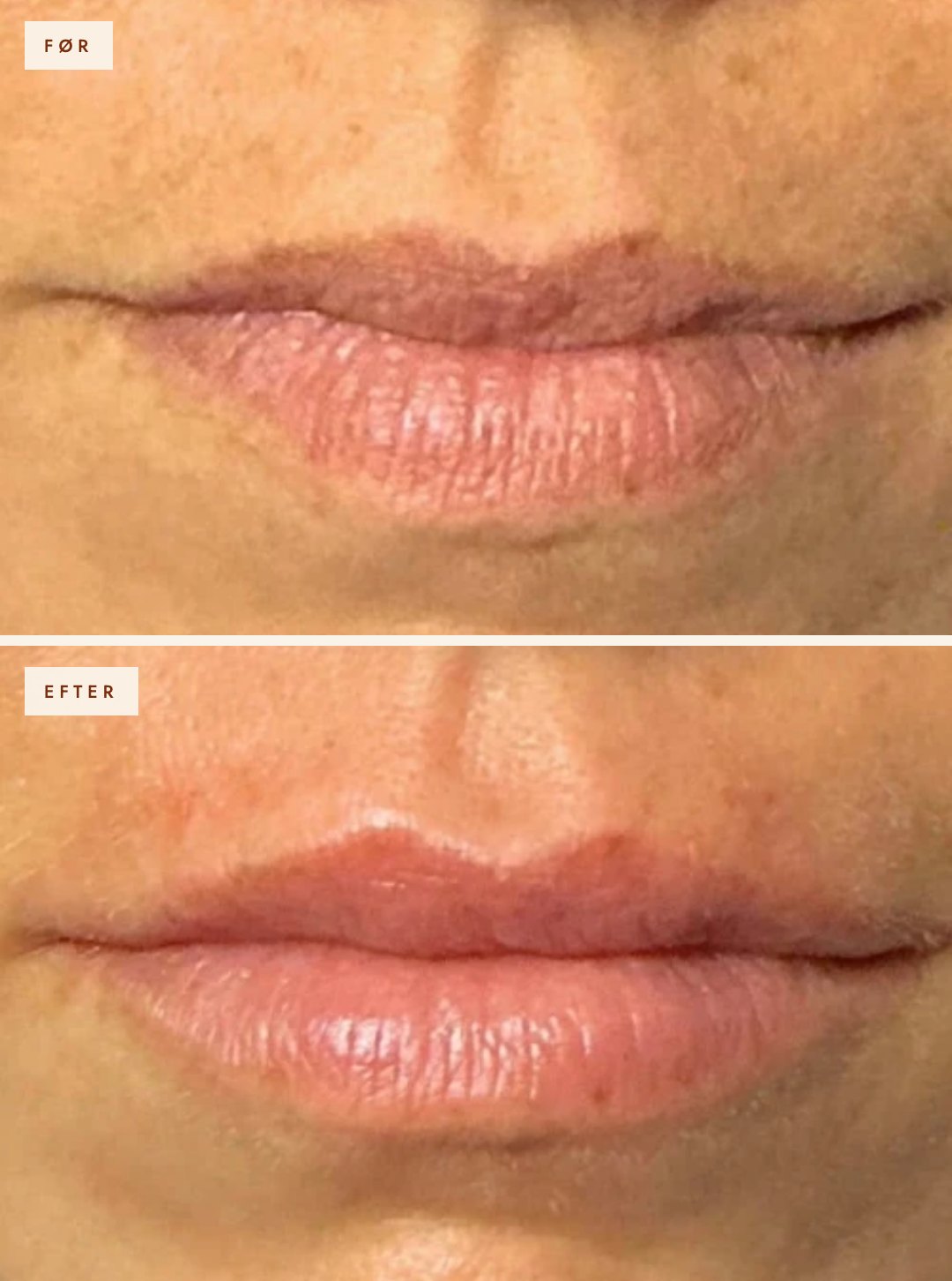 Læber før og efter filler, 1 ml