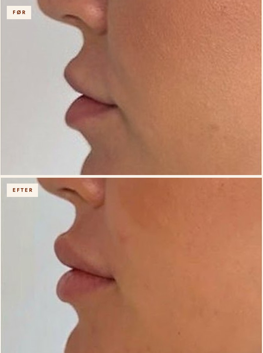 Læber i profil før og efter filler, 1 ml