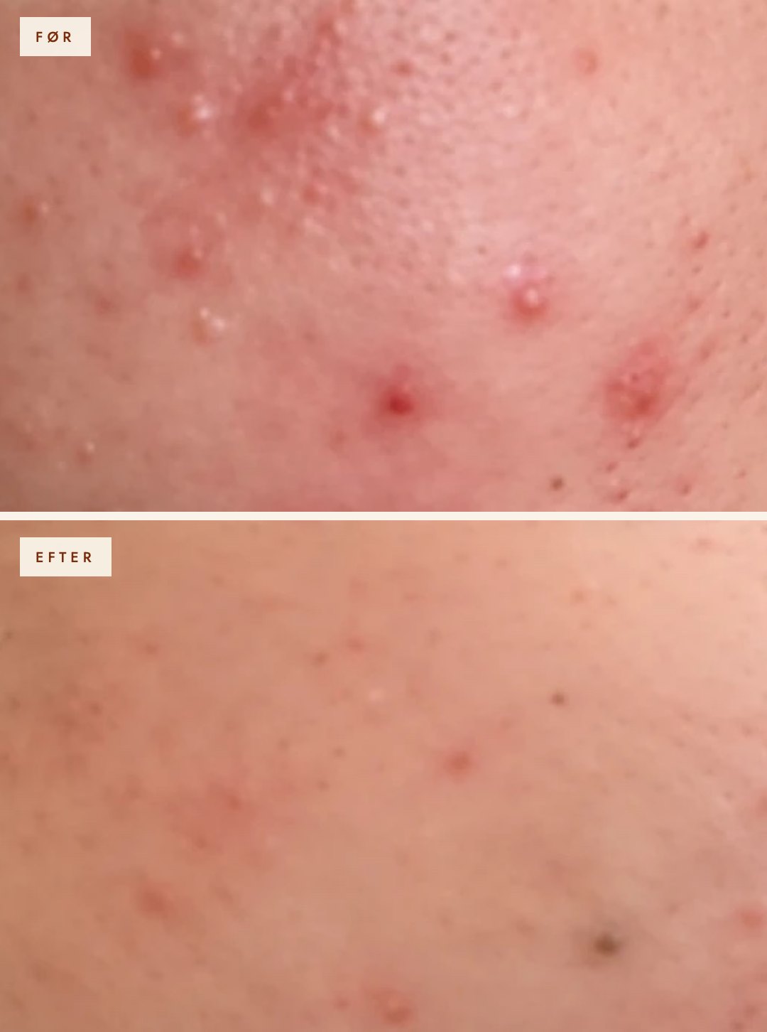 Akne før og efter microneedling med SkinPen