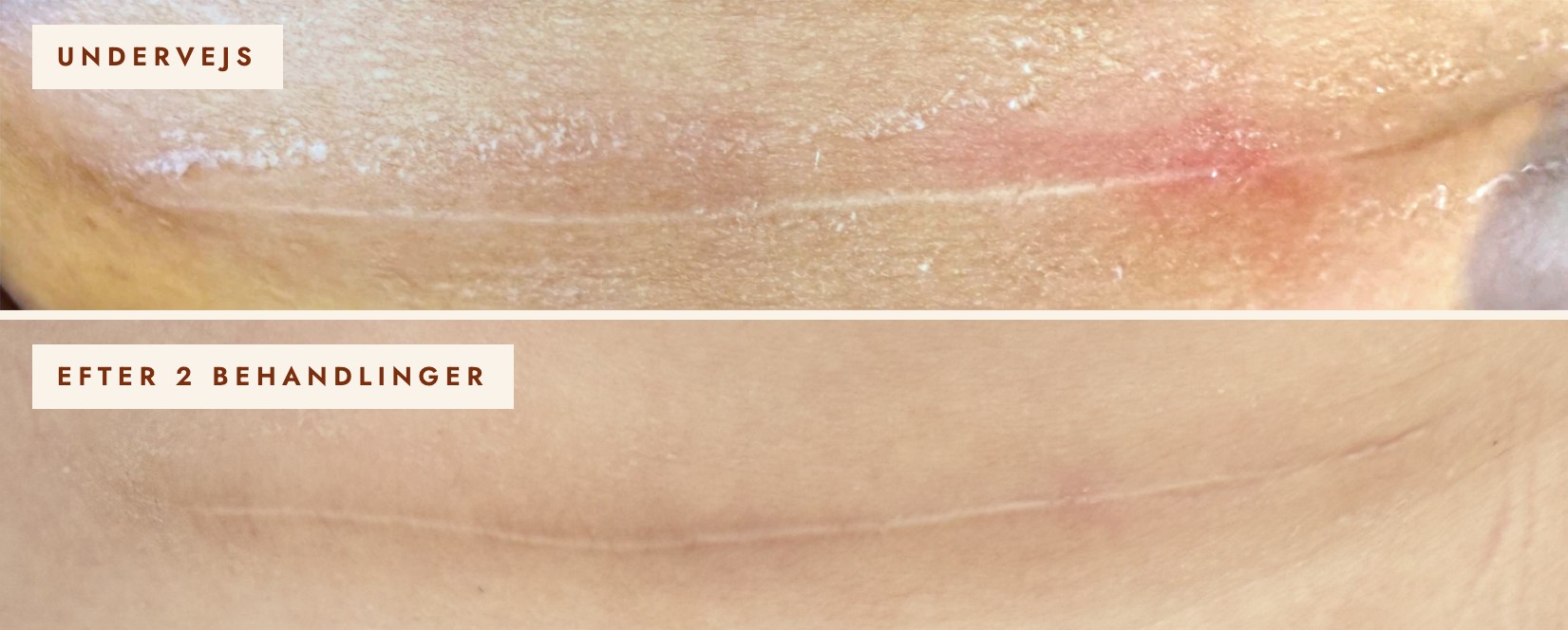 Kejsersnitsar behandlet med SkinPen, en uge efter 2. behandling og efter 2 behandlinger