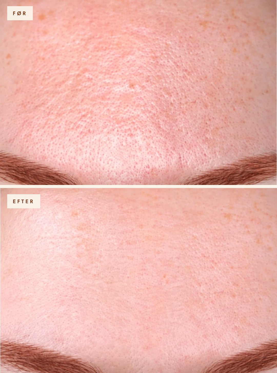 Pande før og efter 3 behandlinger med SkinPen og Skinkò E
