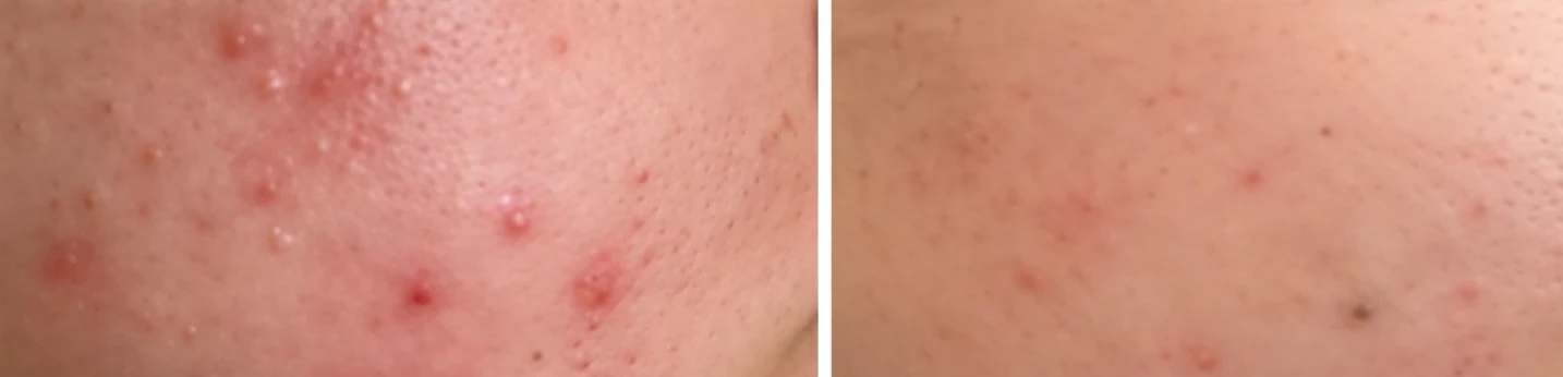 Akne før og efter microneedling med SkinPen