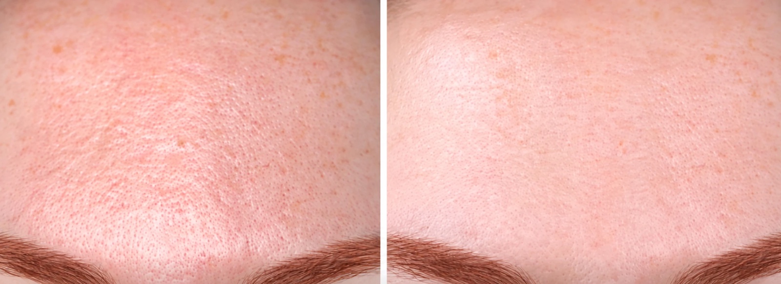 Pande før og efter 3 behandlinger med SkinPen